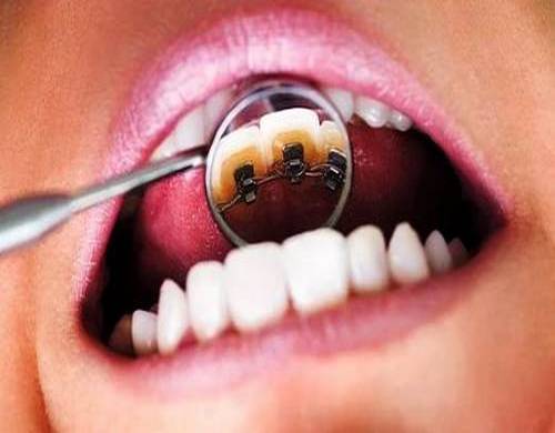 لمینت دندان سرامیکی یا کامپوزیت یعنی چه و ایا تفاوتی هم دارند