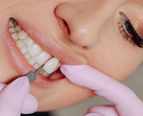 چگونه از لمینت متحرک دندان مراقبت کنید