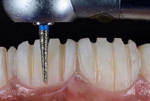 معایب لمینت دندان چیست 