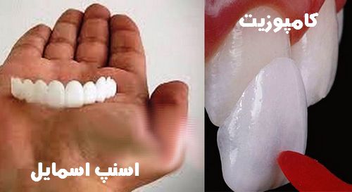 تفاوت لمینت متحرک با سرامیک و کامپوزیت دندان چیست