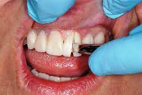 آیا برداشتن لمینت دندان  خطرناک است 
