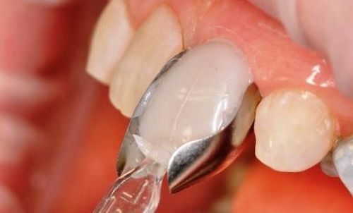 آیا لمینت دندان قابل ترمیم است