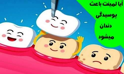 آیا لمینت باعث پوسیدگی دندان میشود 