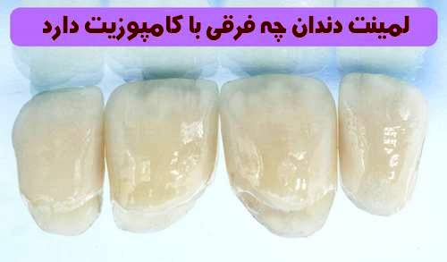 لمینت دندان چه فرقی با کامپوزیت دارد 