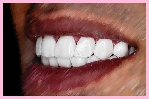 کامپوزیت دندان چیست 