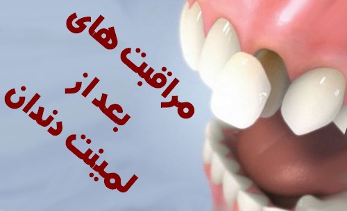 مراقبت های بعد از لمینت دندان 