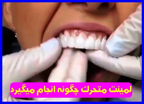 لمینت متحرک دندان چگونه انجام میگیرد 