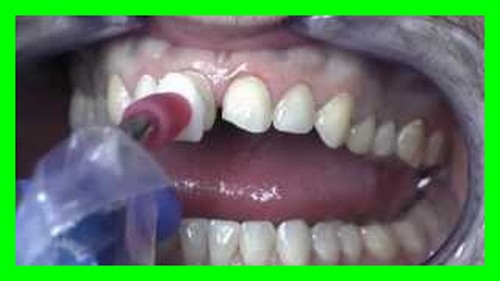 مراحل نصب لمینت دندان را توضیح بدهید +5 مرحله ساده